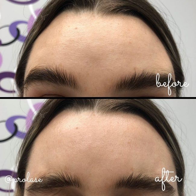 Botox Treatment for Forehead Lines.