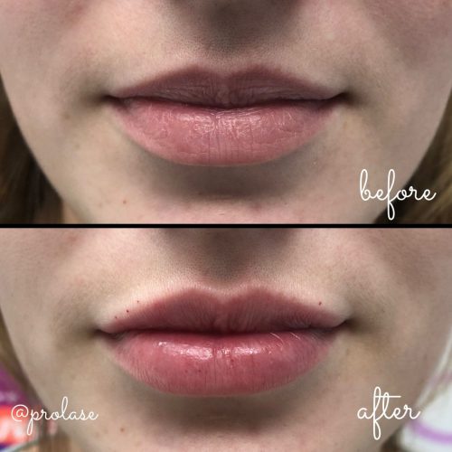 juvederm-lips-before-and-after-prolase-laser-clinic-la-01-