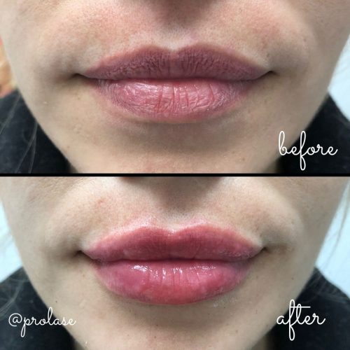juvederm-lips-before-and-after-prolase-laser-clinic-la-02
