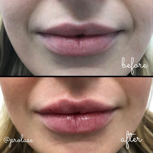 juvederm-lips-before-and-after-prolase-laser-clinic-la-03