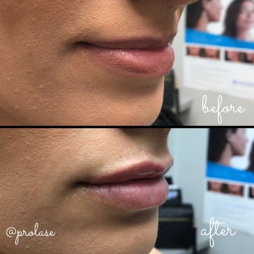 volbella-before-and-after-prolase-laser-clinic-la-01
