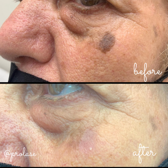 Age spot removal using Intense Pulse Light (IPL) technology. Available at Prolase Laser Clinic.